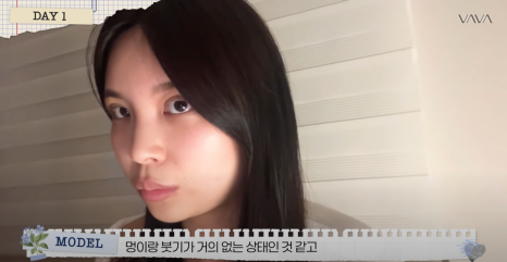 쌍수 재수술 성공기 ｜ 졸려보이는 눈 세미아웃으로 예뻐진 리얼 Before & After 관련 이미지 9