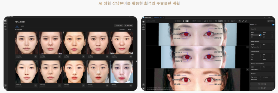 쌍꺼풀 수술 종류 비절개 vs 절개 vs 부분 절개 관련 이미지 8