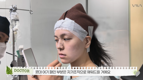 보형물 없이 선명하게｜바바성형외과 무보형물 매부리코 교정 리얼 후기 관련 이미지 8