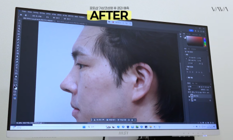 눈&middot;구축코 재수술 후기｜남자 눈코 재수술, 압구정 바바에서 달라진 이유 관련 이미지 11