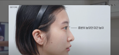 코재수술 원인, 과연 코끝처짐만이 문제일까? 가장 이상적인 라인 알려드립니다 관련 이미지 23
