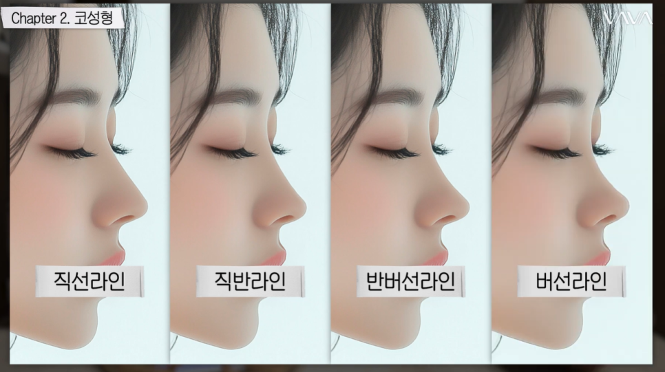 설 연휴 코성형, 회복 기간은 어느 정도 생각해야 할까 관련 이미지 2