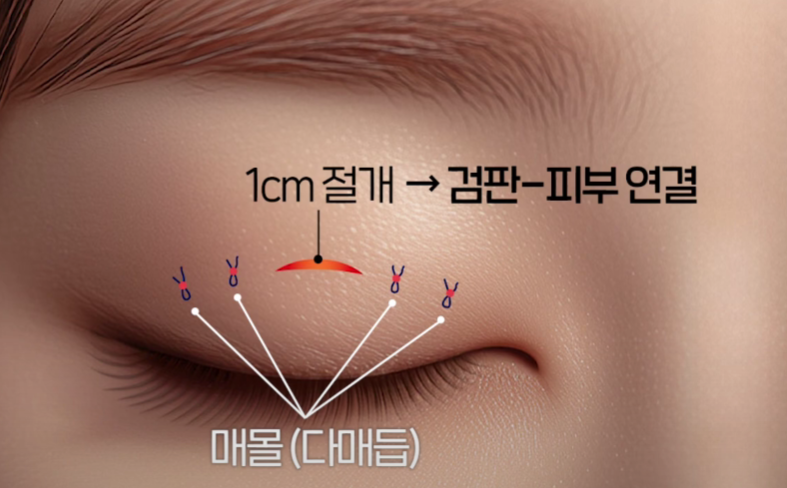 나에게 맞는 쌍꺼풀 수술법 총정리 : 절개, 부분절개, 매몰법까지 관련 이미지 12