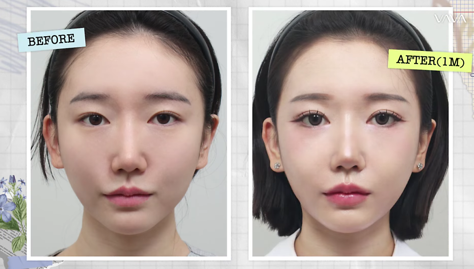 졸려보이는 눈 자연유착 밑트임 위트임으로 또렷하게 (리얼 후기) 관련 이미지 13