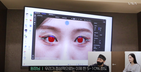 바바성형외과 절개 쌍수 절개 눈매교정 쌍꺼풀  재수술  사례 관련 이미지 6