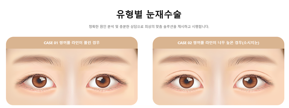 눈 재수술로 보다 완벽한 눈매라인 되찾기 관련 이미지 2