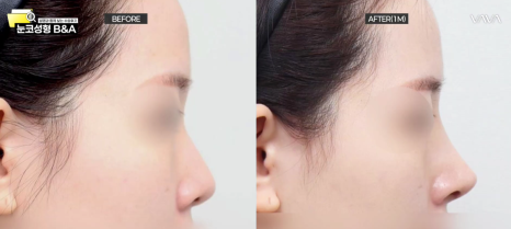 복코 매부리코 긴코 교정 ㅣ 코성형 전후 케이스 (NJZ민지 코) 관련 이미지 11
