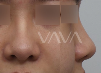 복코 수술전후 개선 된 인상 관련 이미지 2