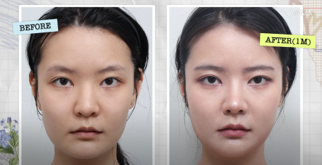 바바성형외과 복코&middot;매부리코&middot;휜코 동시 교정! 직반라인 코성형 리얼 후기 관련 이미지 16