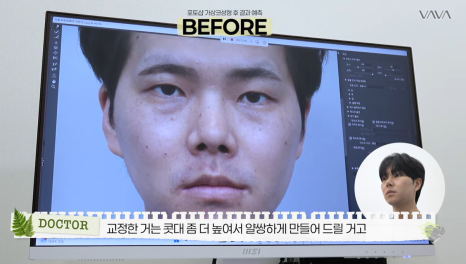 눈&middot;구축코 재수술 후기｜남자 눈코 재수술, 압구정 바바에서 달라진 이유 관련 이미지 12