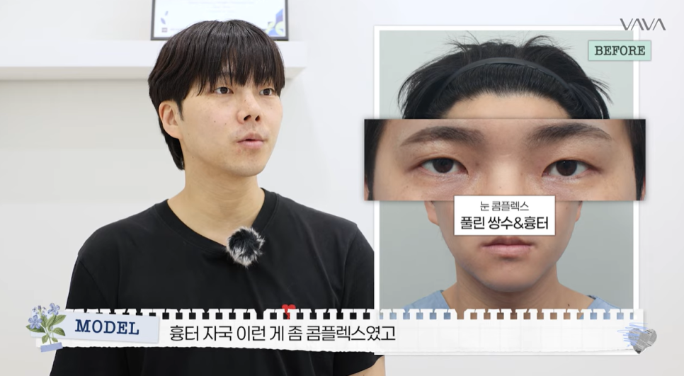 눈&middot;구축코 재수술 후기｜남자 눈코 재수술, 압구정 바바에서 달라진 이유 관련 이미지 5