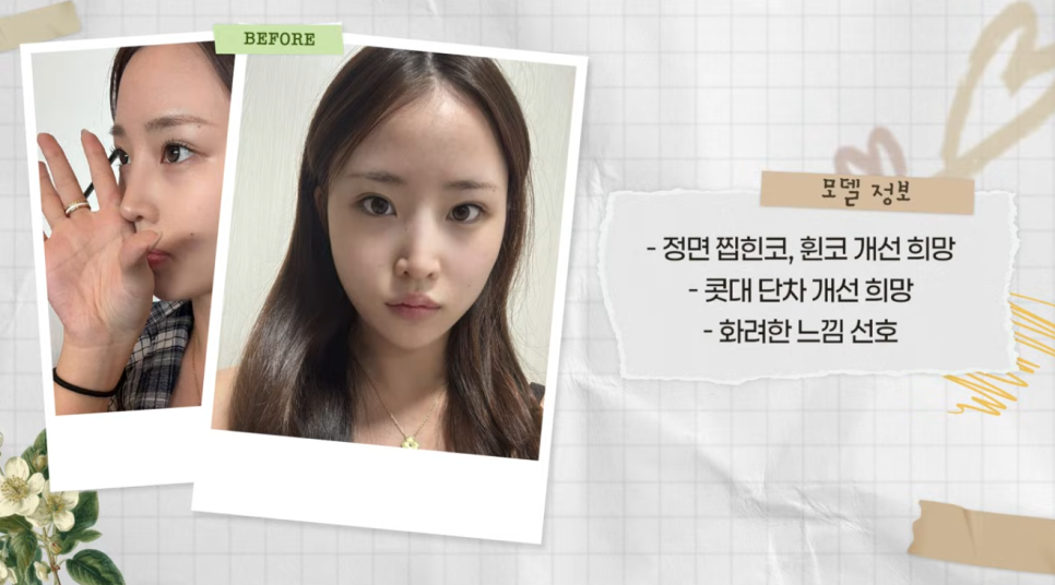 코재수술로 인상까지 달라질 수 있을까?｜바바성형외과 직반라인 코재수술 후기 관련 이미지 2