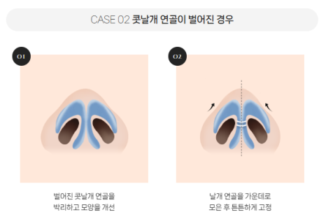 복코, 매부리코, 낮은코 | 바바성형외과 유형별 코성형, 내 코에 맞는 방향 찾기 관련 이미지 7