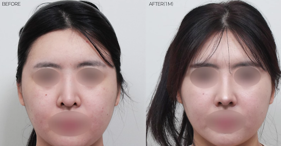 예쁜 코의 공통점은? 성형외과 원장이 알려주는 코 성형 성공하는 방법(리얼 후기 케이스) 관련 이미지 22