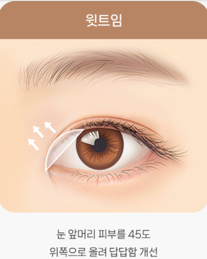 트임이 필요한 눈매와 트임 수술법 관련 이미지 4