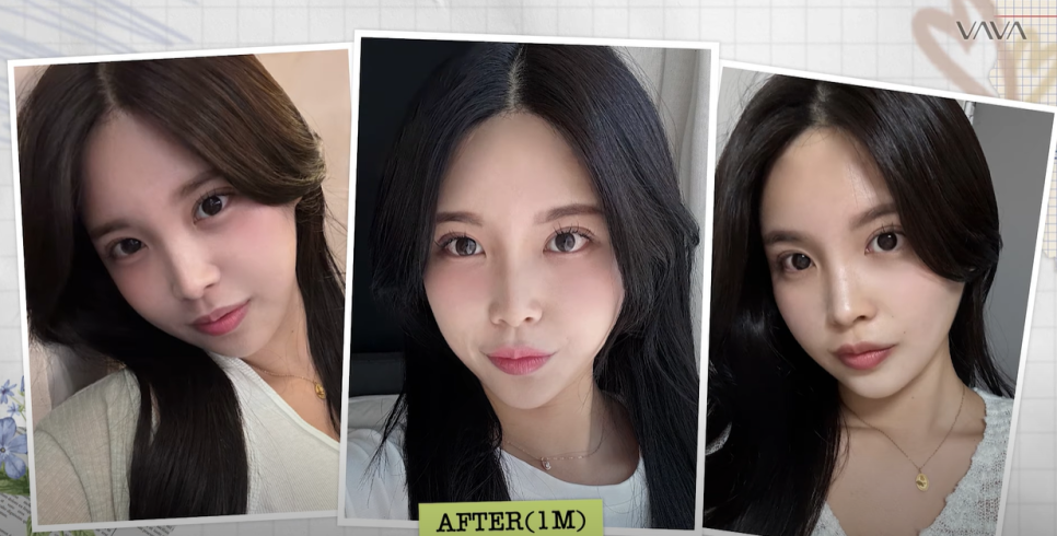 쌍수 재수술 성공기 ｜ 졸려보이는 눈 세미아웃으로 예뻐진 리얼 Before & After 관련 이미지 17