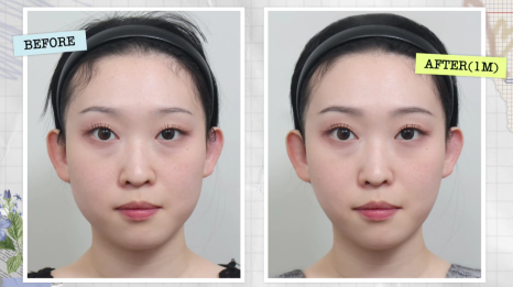 울쎄라 효과 언제부터? 윤곽까지 바뀌는 리프팅, 압구정 바바성형외과(리얼후기) 관련 이미지 2