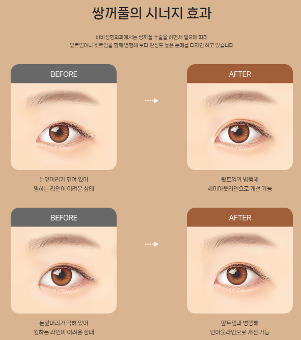 If You’re Concerned About a Tight-Looking Eye Shape | When Medial Epicanthoplasty & Upper Epicanthoplasty Are Needed and How They Differ at 바바성형외과 image 5