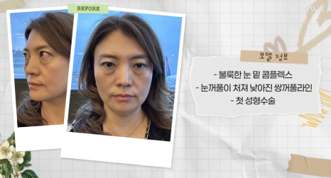 50대에도 자신감 가득 엄마의 두번째 리즈시절, 중년 눈성형&middot;하안검&middot;이마거상 리얼 후기 관련 이미지 3
