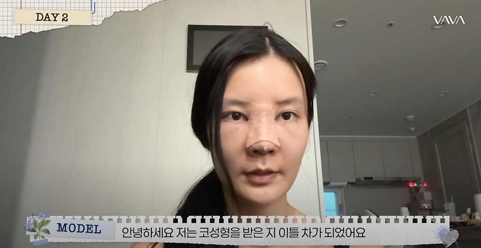 바바성형외과 복코&middot;매부리코&middot;휜코 동시 교정! 직반라인 코성형 리얼 후기 관련 이미지 11