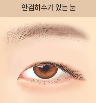 자연유착 VS 절개  어떤 기준으로 선택해야 할까? 관련 이미지 11