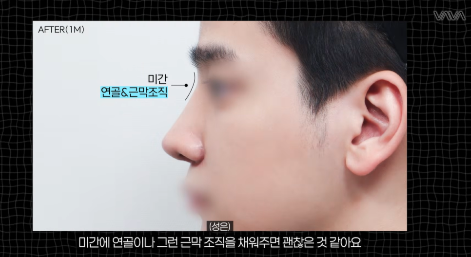 코성형 재료 총정리｜실리콘 부작용&middot;자가늑연골 와핑&middot;귀연골 흡수까지 (콧대 코끝 비교) 관련 이미지 10