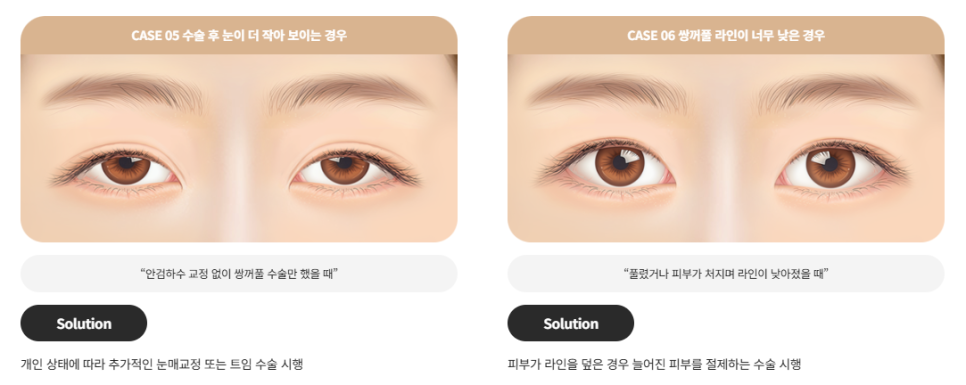 Revision Double Eyelid Surgery May Not Be Just a Line Issue | When Revision Eyelid Surgery Is Needed at Baba Plastic Surgery image 4