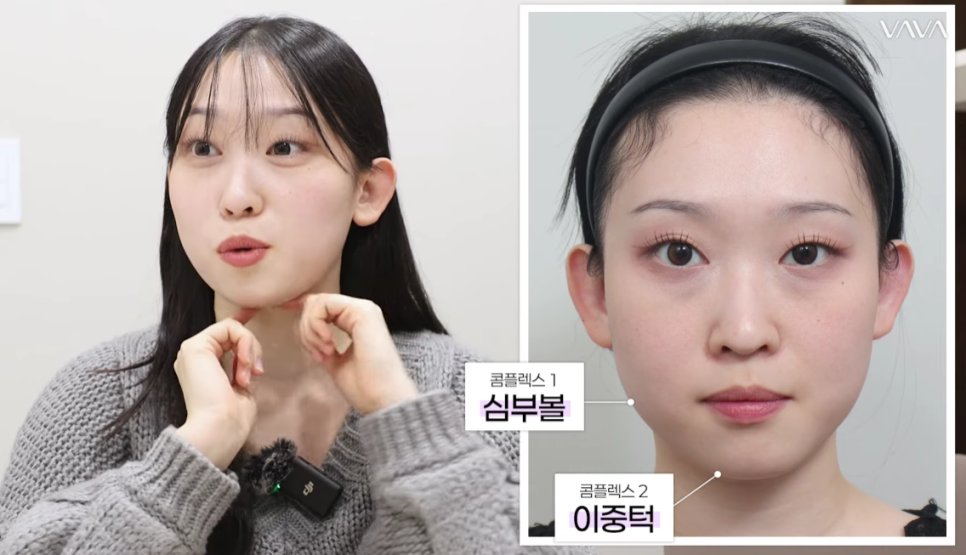 울쎄라 효과 언제부터? 윤곽까지 바뀌는 리프팅, 압구정 바바성형외과(리얼후기) 관련 이미지 17