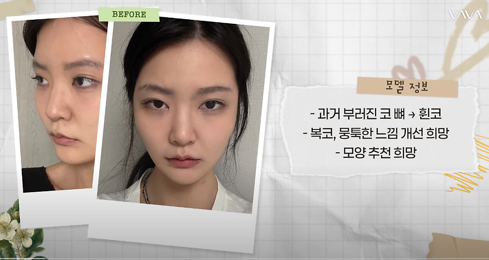 바바성형외과 복코&middot;매부리코&middot;휜코 동시 교정! 직반라인 코성형 리얼 후기 관련 이미지 3