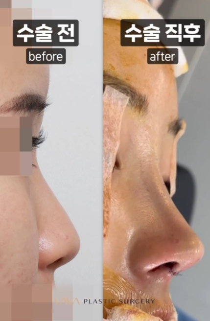 코 성형 후 붓기 기간과 붓기 관리방법 관련 이미지 7