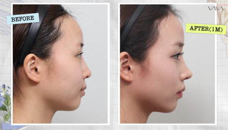 코재수술로 인상까지 달라질 수 있을까?｜바바성형외과 직반라인 코재수술 후기 관련 이미지 17