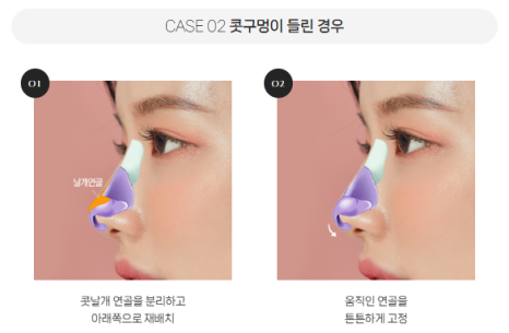 복코, 매부리코, 낮은코 | 바바성형외과 유형별 코성형, 내 코에 맞는 방향 찾기 관련 이미지 21