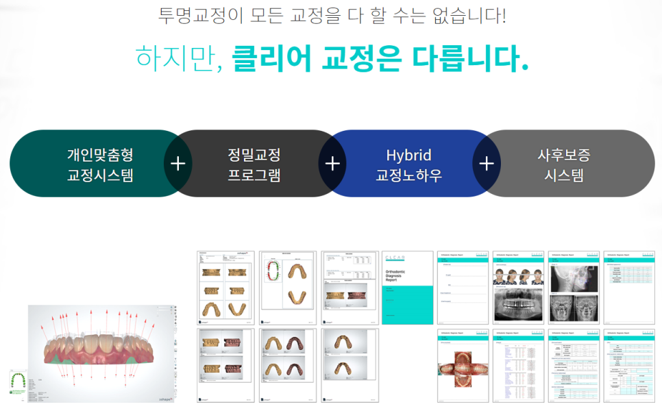 앞니 부분교정 비용 불편함이 적은 클리피씨 관련 이미지 4