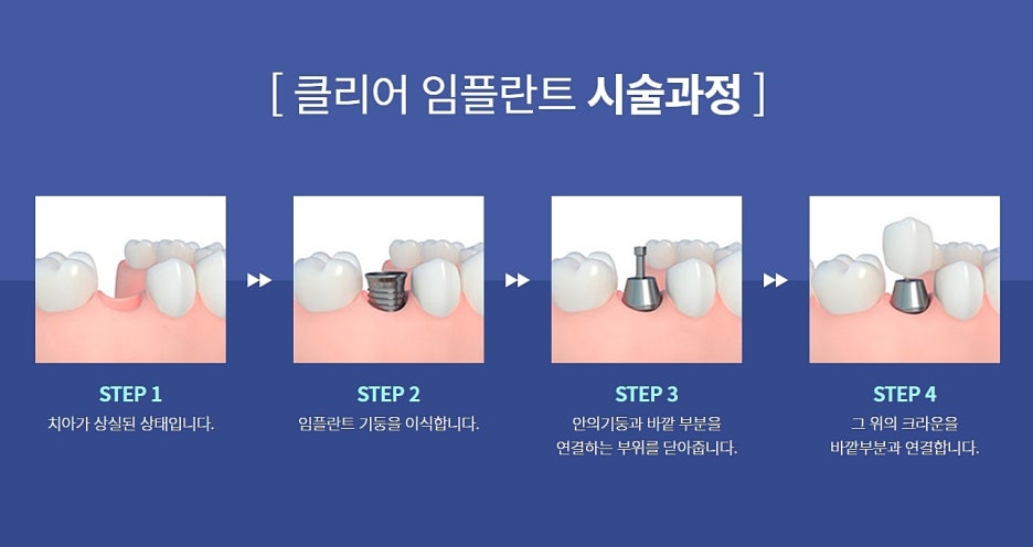 클리어치과 임플란트 치료의 중요성은 관련 이미지 5