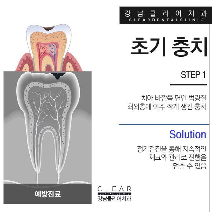 강남역충치치료 단계별 달리지는 치료방법 관련 이미지 4