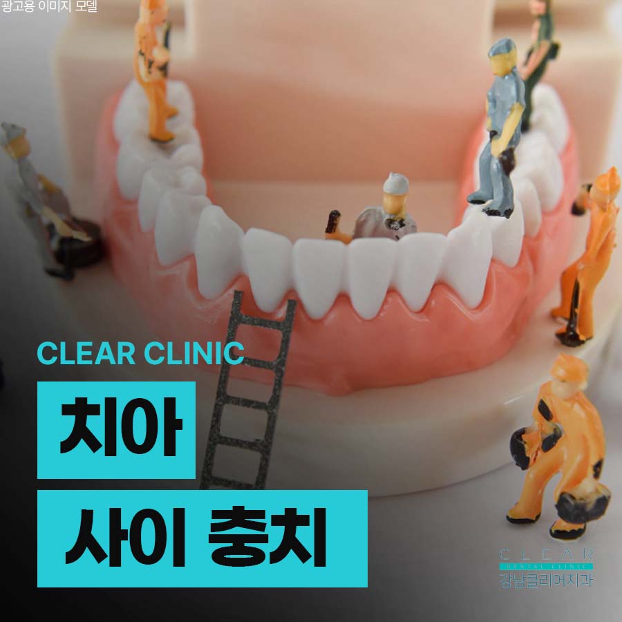 치아 사이 충치 원인 치료방법 정리해봐요 관련 이미지 1