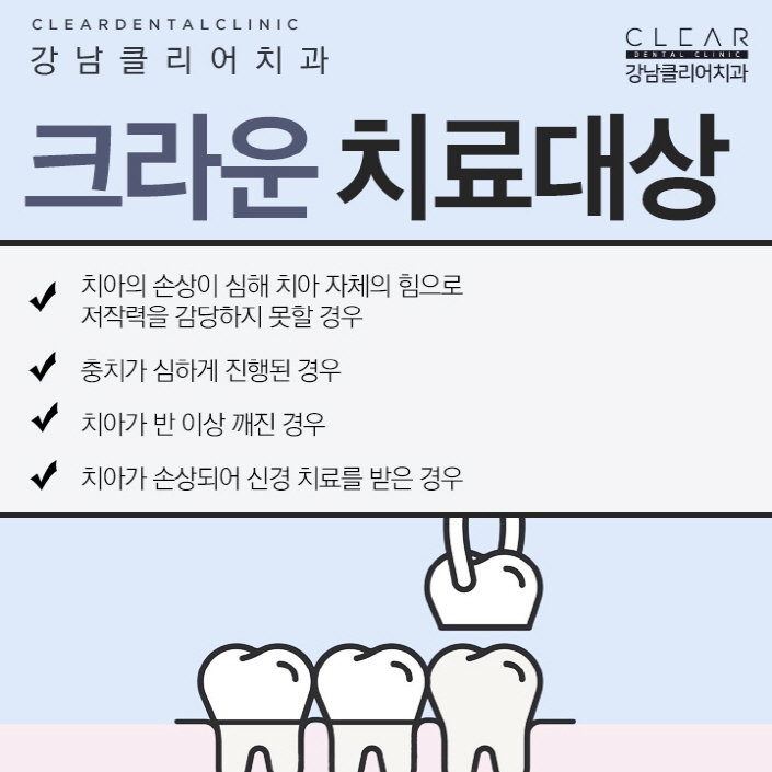 치아 크라운 치료 어떤 종류가 있고 언제 필요한가? 관련 이미지 3