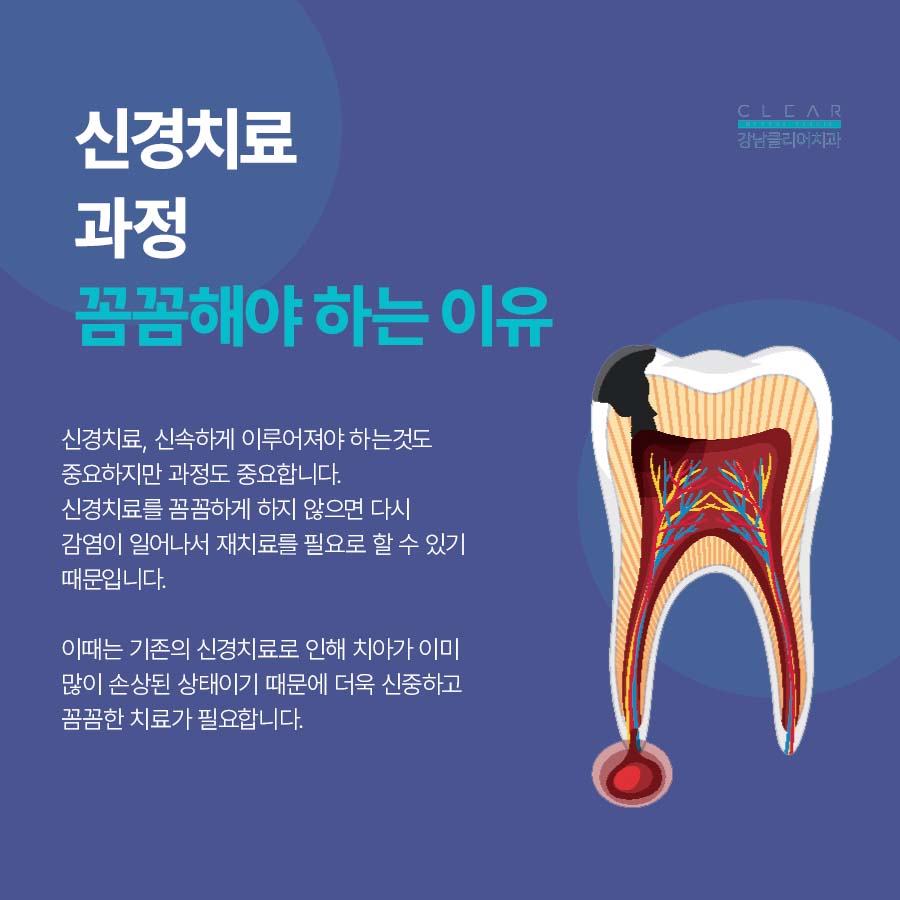 클리어치과 신경치료 과정 꼼꼼해야 하는 이유 관련 이미지 3
