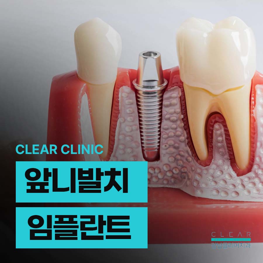 앞니발치 임플란트 난이도가 높은 이유 관련 이미지 1