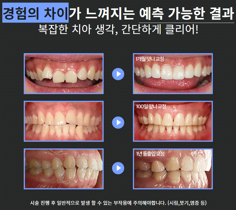치아 부정교합 강남역치과에서 상담부터 관련 이미지 2