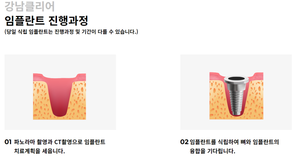 강남 논현동 임플란트잘하는곳 체계적인 맞춤 치료를 관련 이미지 6