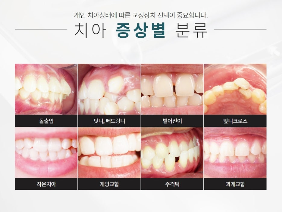 교정전문치과 매력적인 미소를 원해 관련 이미지 7