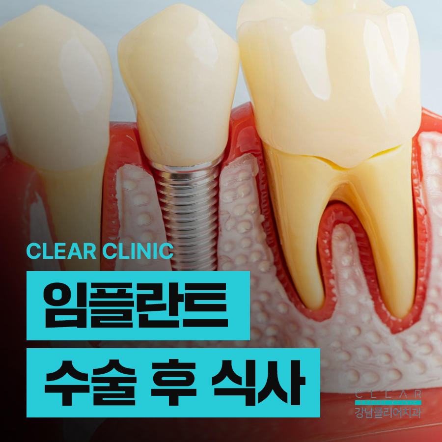임플란트 수술 후 식사 주의할점 알아봐요 관련 이미지 1