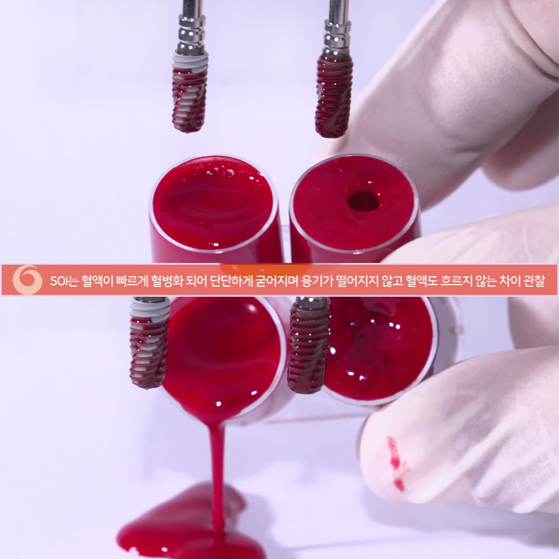 오스템임플란트 SOI임플란트 무엇이 다를까요? 관련 이미지 6