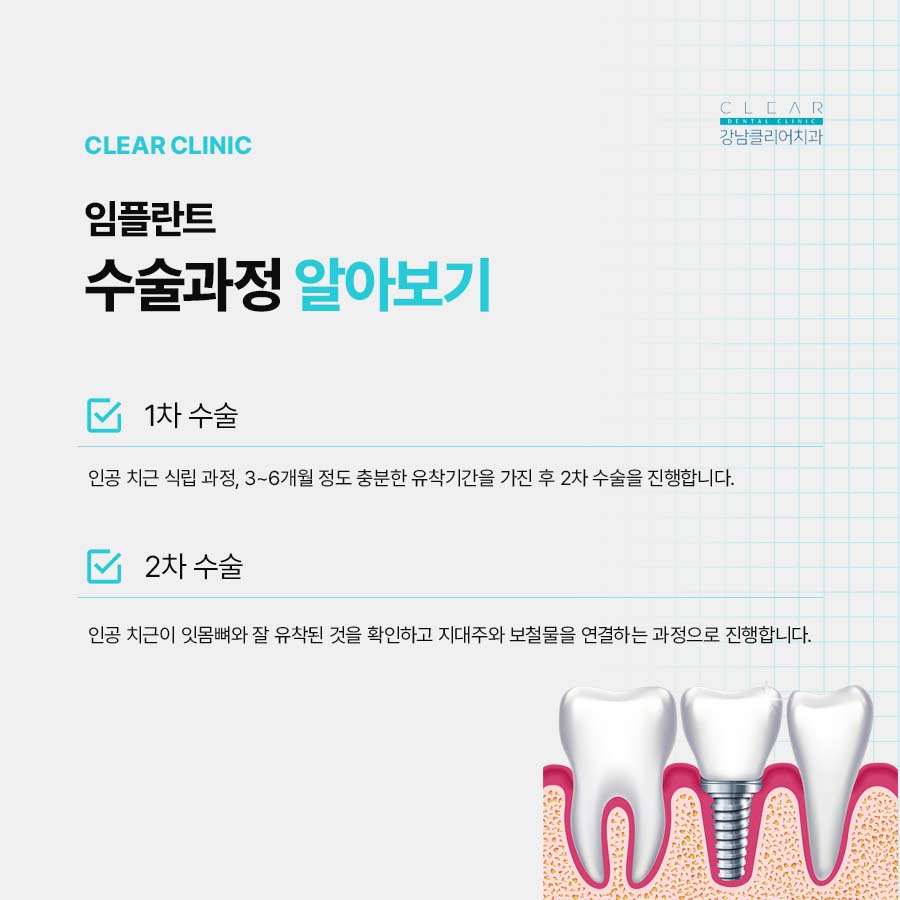 신논현 임플란트 구조 수술과정 총정리 관련 이미지 4