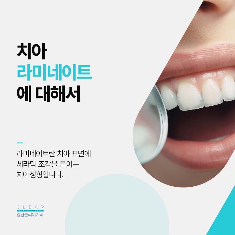 라미네이트 치아삭제 주의할 점 정리 관련 이미지 2