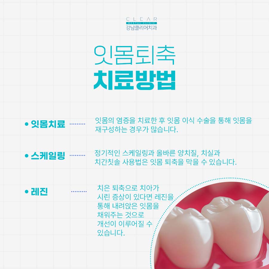 잇몸퇴축 치료 치실과 치간칫솔 사용법 중요해 관련 이미지 4