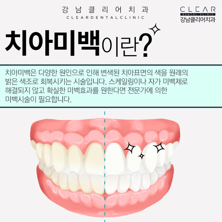강남치아미백 미백단계까지 조절가능한 치과치아미백 관련 이미지 3