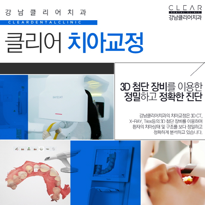 치아부분교정 앞니부분교정 정확한 진단이 중요 관련 이미지 4