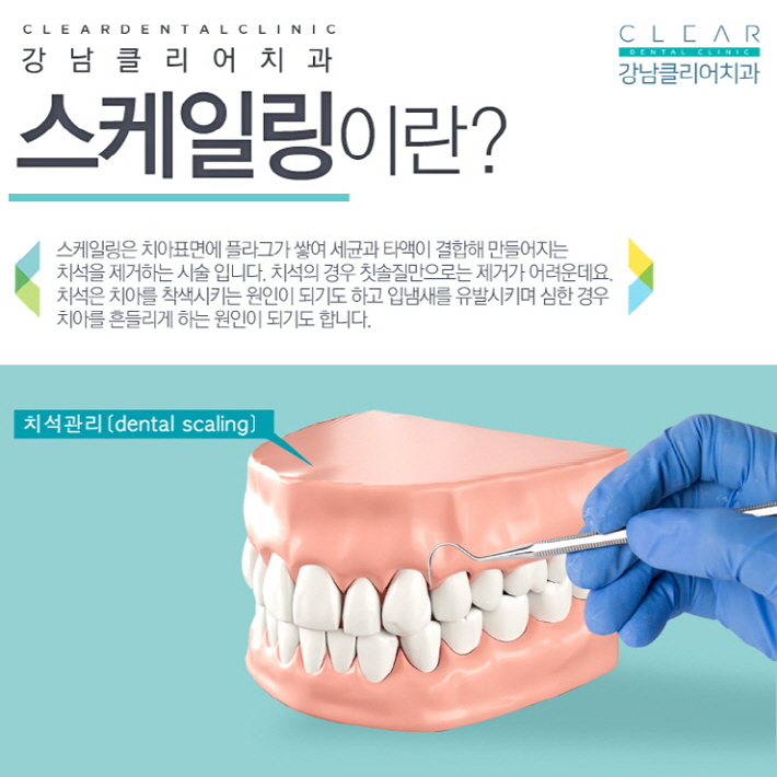 치아 스케일링 가격 건강보험 적용으로 부담없이 관련 이미지 2